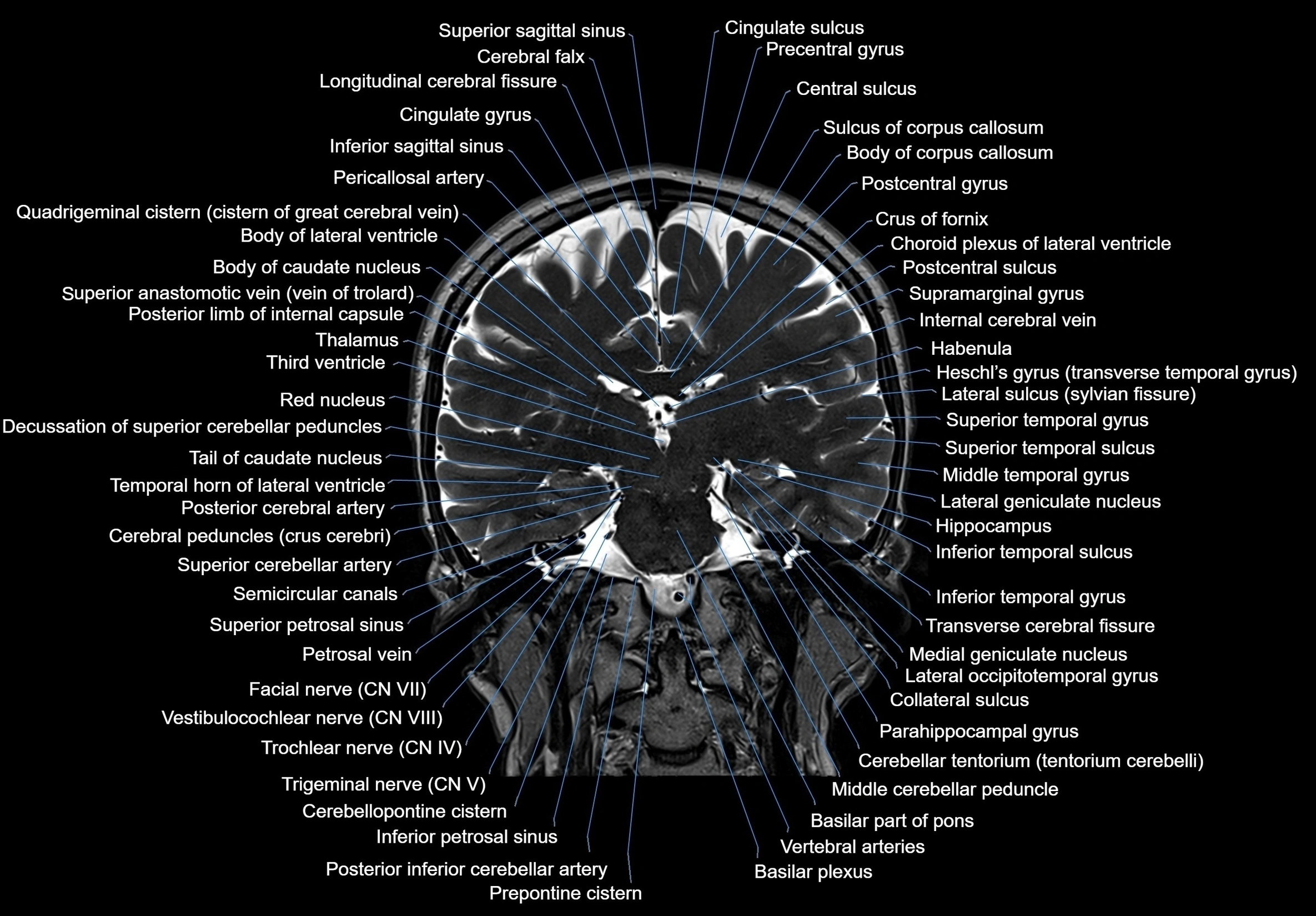 MRI Brain coronal cross sectional labelled anatomy 3T image  -img-00001-00043.webp